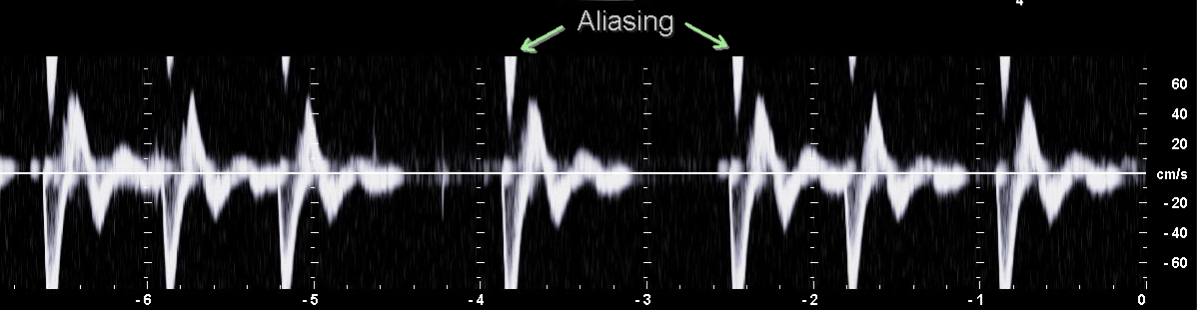 PW-Dopplerspektrum mit Aliasing-Artefakt bei mittig eingestellter Nulllinie