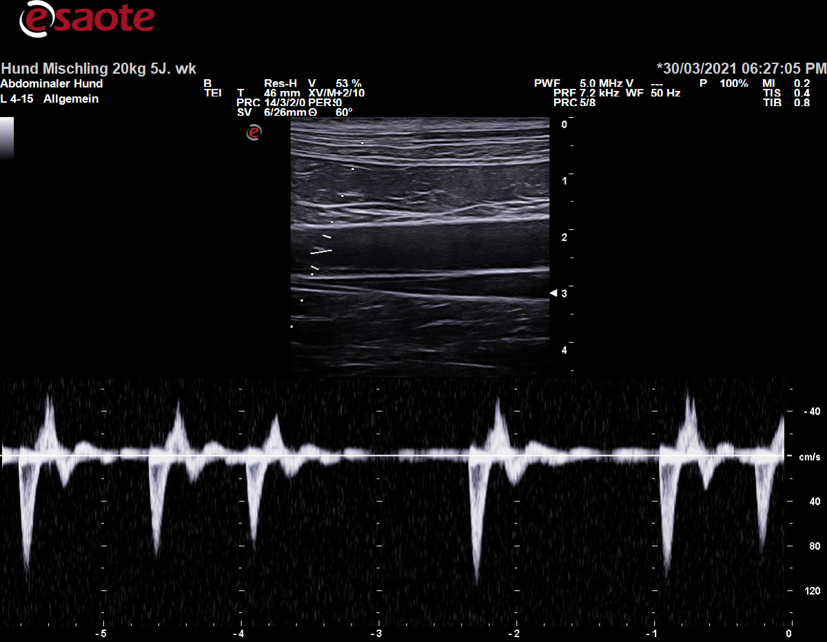 Anwendung des PW-Doppler am Beispiel der Aorta mit Richtungsumkehr