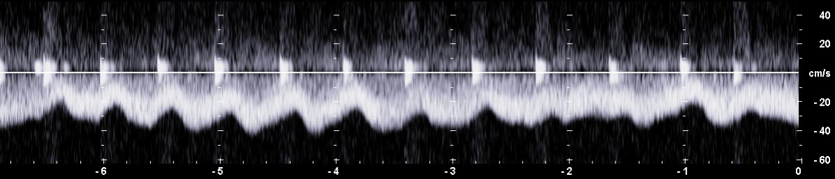 Wellenförmiges PW-Dopplerspektrum der Vena portae bei einem Hund mit frequenter Atmung