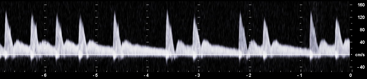 PW-Dopplerspektrum der Arteria celiaca mit einem abgestumpft parabolischem Profil