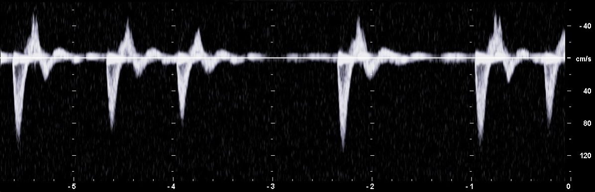 PW-Dopplerspektrum mit guter Doppler-Gain-Einstellung