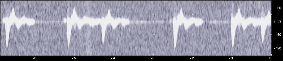 PW-Dopplerspektrum mit Hintergrundrauschen
