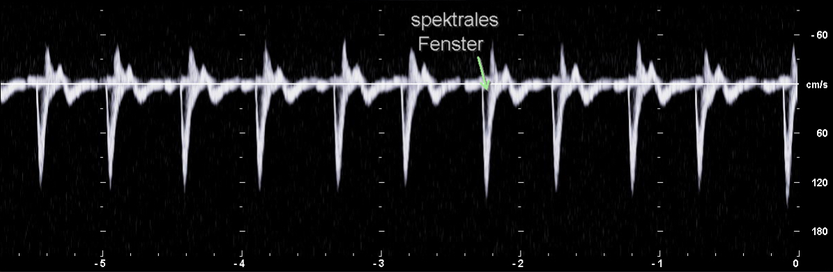 PW-Dopplerspektrum eines Hochwiderstandsgefäßes am Beispiel der Arteria iliaca externa