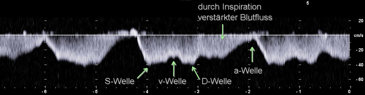 PW-Dopplerspektrum der Vena cava caudalis im kranialen Abdomen (auf Höhe der Leber) mit Beschriftung