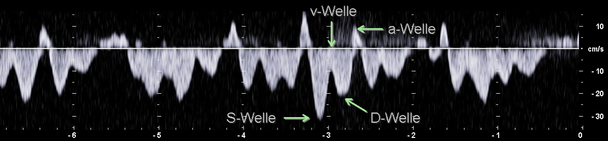 PW-Dopplerspektrum einer Vena hepatica mit Beschriftung
