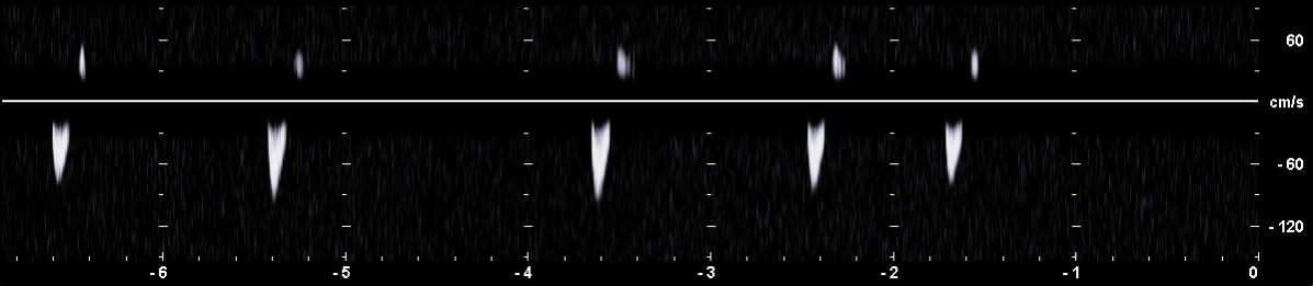 PW-Dopplerspektrum der Aorta abdominalis mit einer viel zu hohen Wandfilter-Einstellung und dadurch fehlenden Flussinformationen