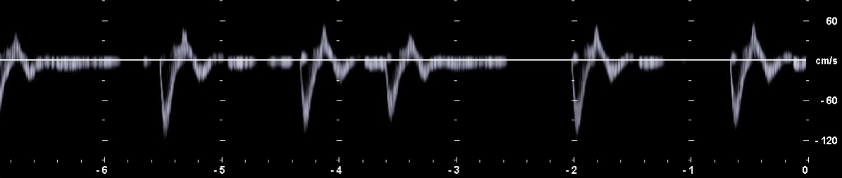 PW-Dopplerspektrum mit zu geringer Doppler-Gain-Einstellung
