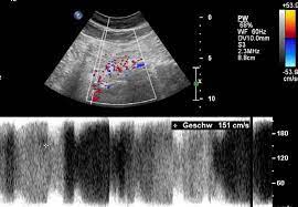Ultraschallbild Musikalische Bänder im PW-Doppler
