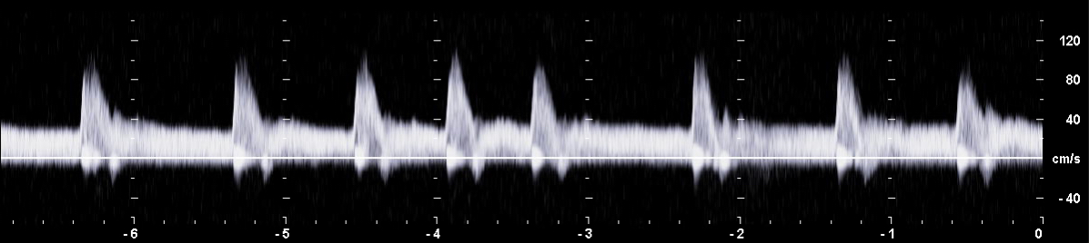 PW-Dopplerspektrum einer Arteria renalis mit einem parabolischem Geschwindigkeitsprofil