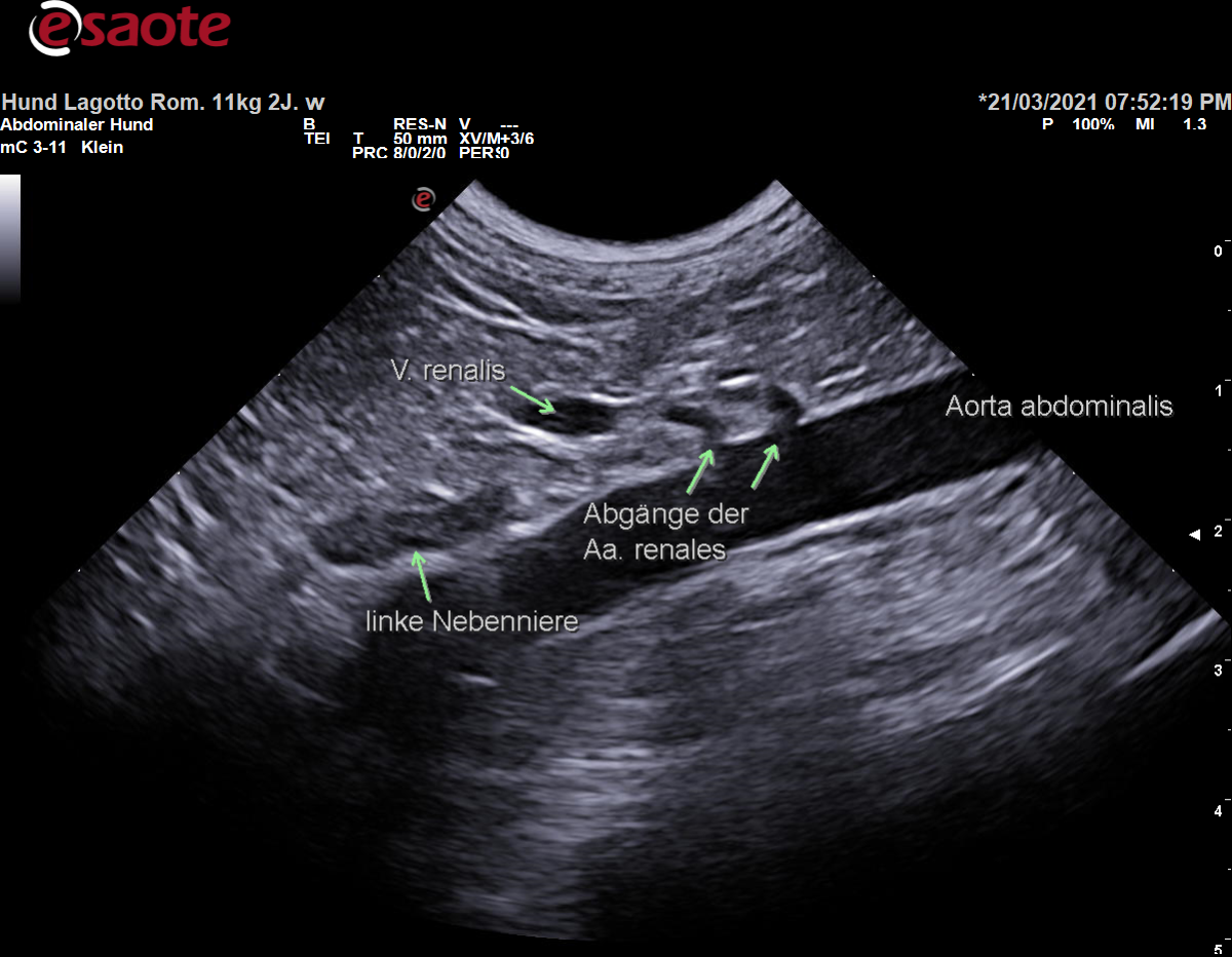 Darstellung der Abgänge der doppelt angelegten Arteriae renales auf der linken Seite (häufige Gefäßvariante) aus der Aorta abdominalis im B-Bild mit Beschriftung