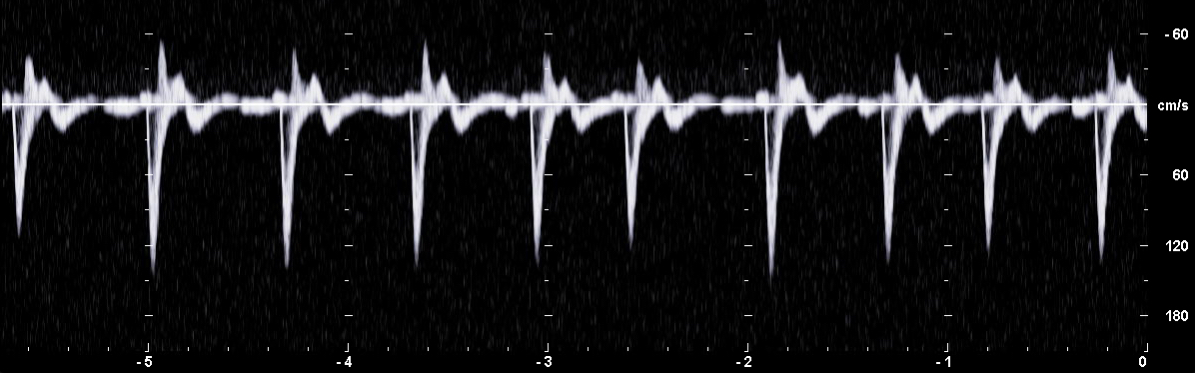 PW-Dopplerspektrum mit schmaler Verteilung von Strömungsgeschwindigkeiten in einer Arterie