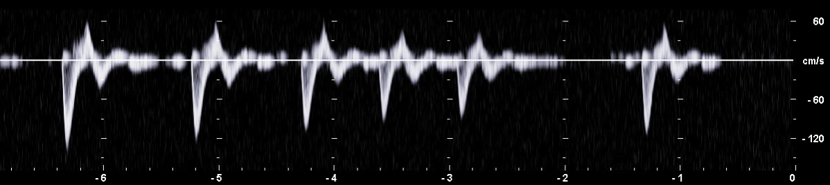 PW-Dopplerspektrum mit erhöhter Pulsrepititionsfrequenz (PRF) und asymmetrisch eingestellter Nulllinie