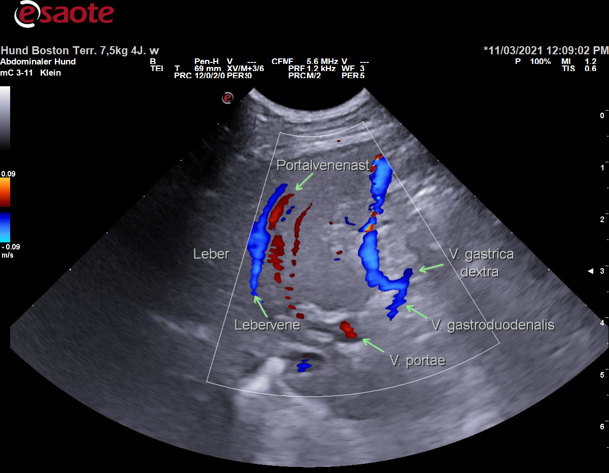 Darstellung der Vena gastroduodenalis im Verlauf Richtung Vena portae mit Zufluss der Vena gastrica dextra im Farbdoppler mit Beschriftung