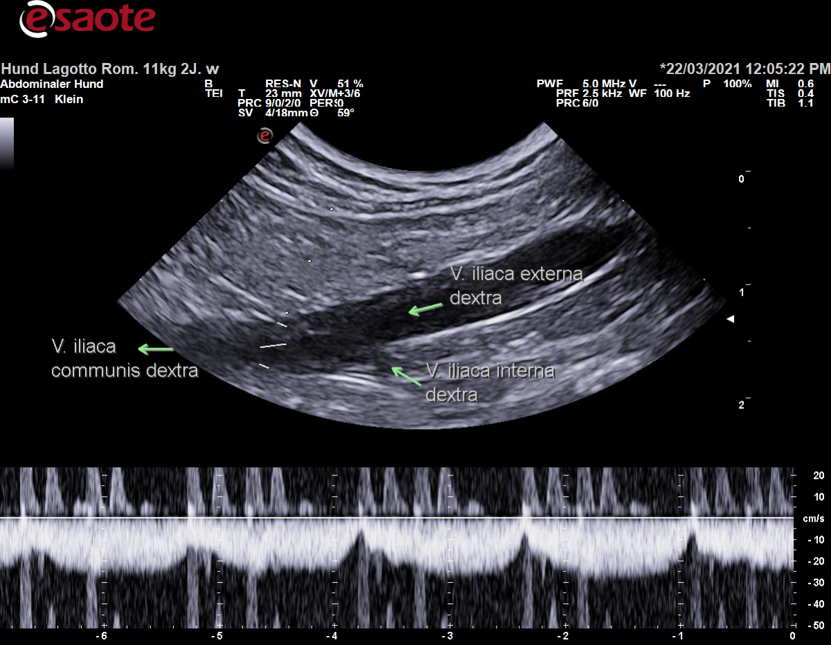 Konventionelle Duplexsonographie der Vena iliaca communis dextra mit dem PW-Doppler