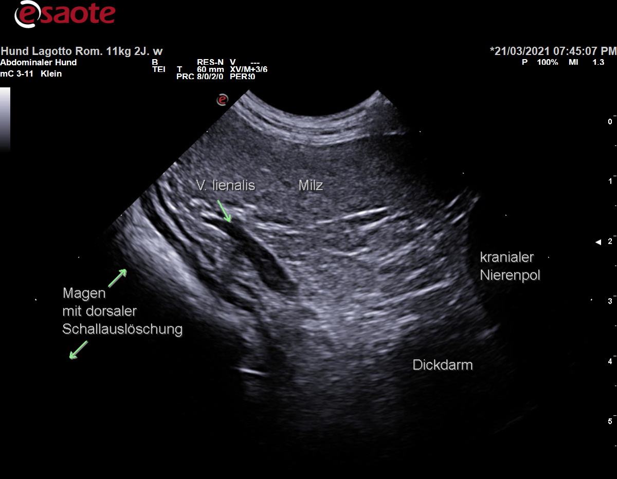 Darstellung der Vena lienalis im Verlauf Richtung Vena portae im B-Bild mit Beschriftung