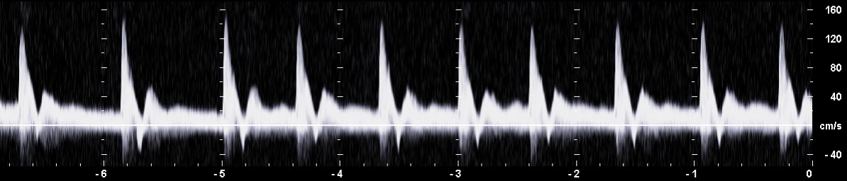 PW-Dopplerspektrum der Arteria mesenterica cranialis mit einem abgestumpft parabolischem Profil